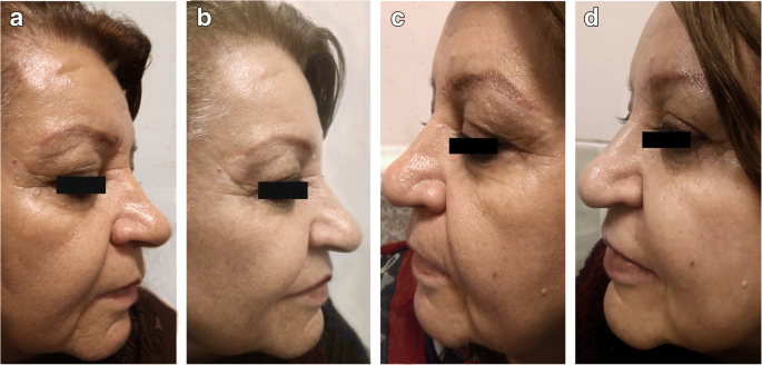 Efficacy and safety of long pulse Nd:YAG laser versus fractional erbium:YAG  laser in the treatment of facial skin wrinkles | SpringerLink