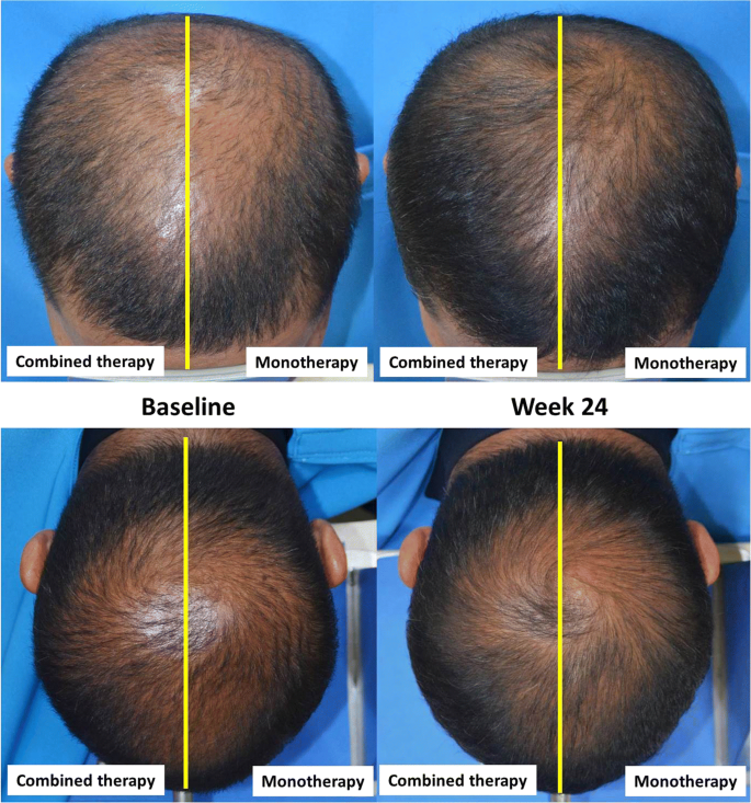 A randomized, investigator-blinded, controlled, split-scalp study of the efficacy and safety of a 1550-nm fractional erbium-glass laser, used in combination with topical 5% versus 5% minoxidil alone, for the treatment of