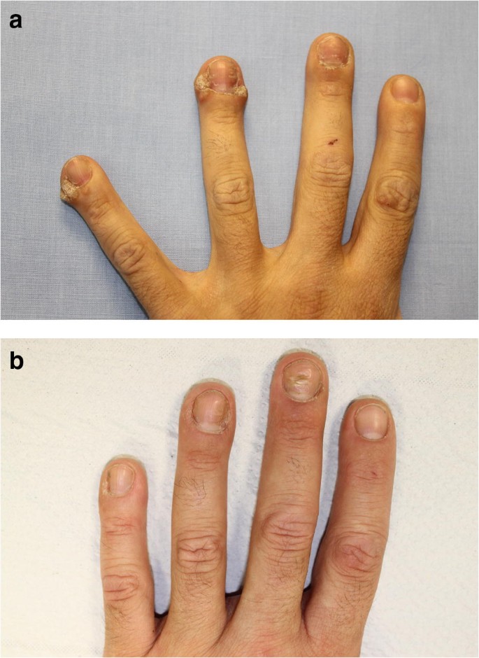Recalcitrant Viral Warts Treated With Photodynamic Therapy Methyl Aminolevulinate And Red Light 630 Nm A Case Series Of 51 Patients Springerlink