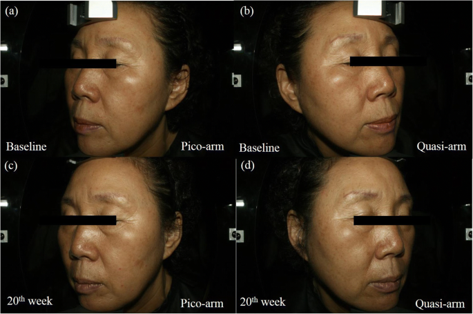 Split-face comparison of the picosecond 1064-nm Nd:YAG laser using a  microlens array and the quasi-long-pulsed 1064-nm Nd:YAG laser for  treatment of photoaging facial wrinkles and pores in Asians | SpringerLink