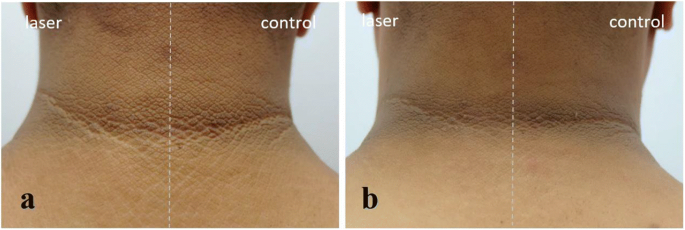 Comparison of the effectiveness of fractional 1550-nm erbium fiber laser  and 0.05% tretinoin cream in the treatment of acanthosis nigricans: a  prospective, randomized, controlled trial | SpringerLink