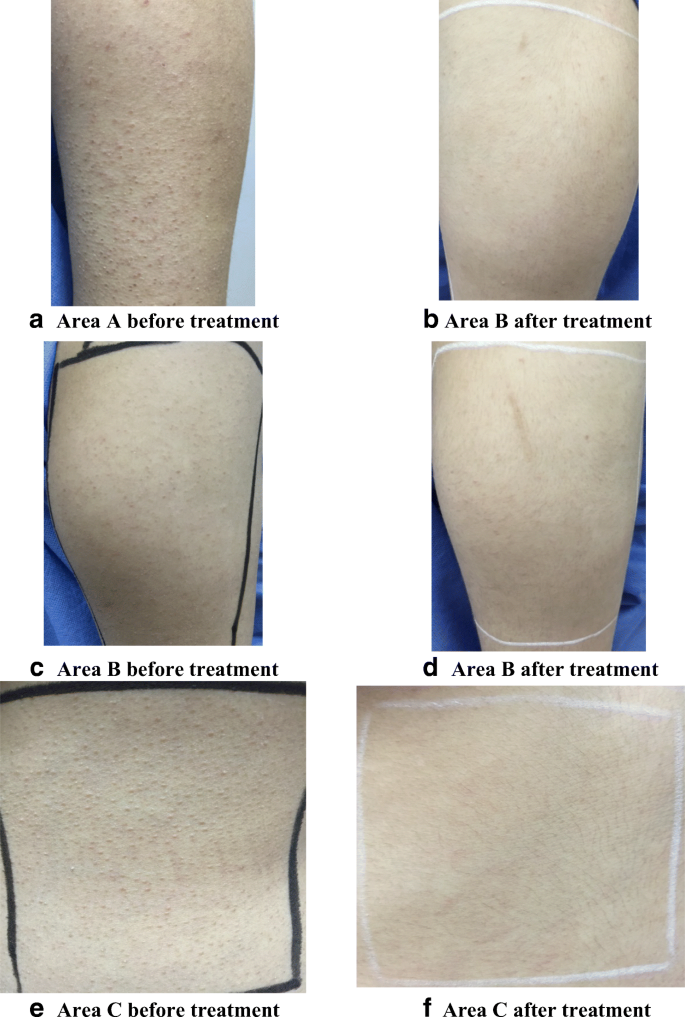 Comparative study between the efficacy of fractional CO2 laser, Q-switched  Nd:YAG laser (1064 nm), and both types in treatment of keratosis pilaris” |  SpringerLink
