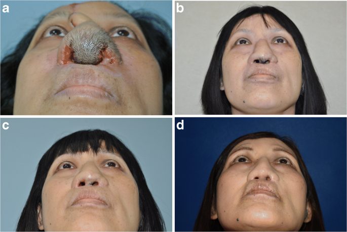 Laser hair removal following forehead flap for nasal reconstruction |  SpringerLink