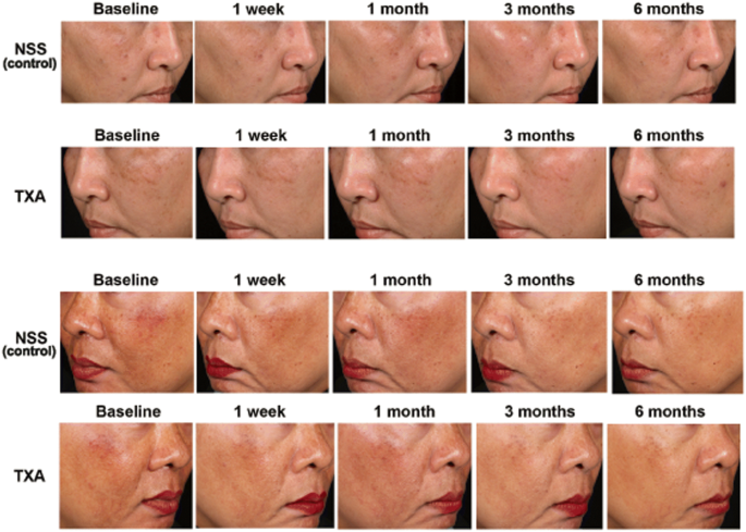 glutathione mesotherapy for melasma The efficacy in treatment of facial melasma with thulium 1927-nm fractional  laser-assisted topical tranexamic acid delivery: a split-face,  double-blind, randomized controlled pilot study | Lasers in Medical Science