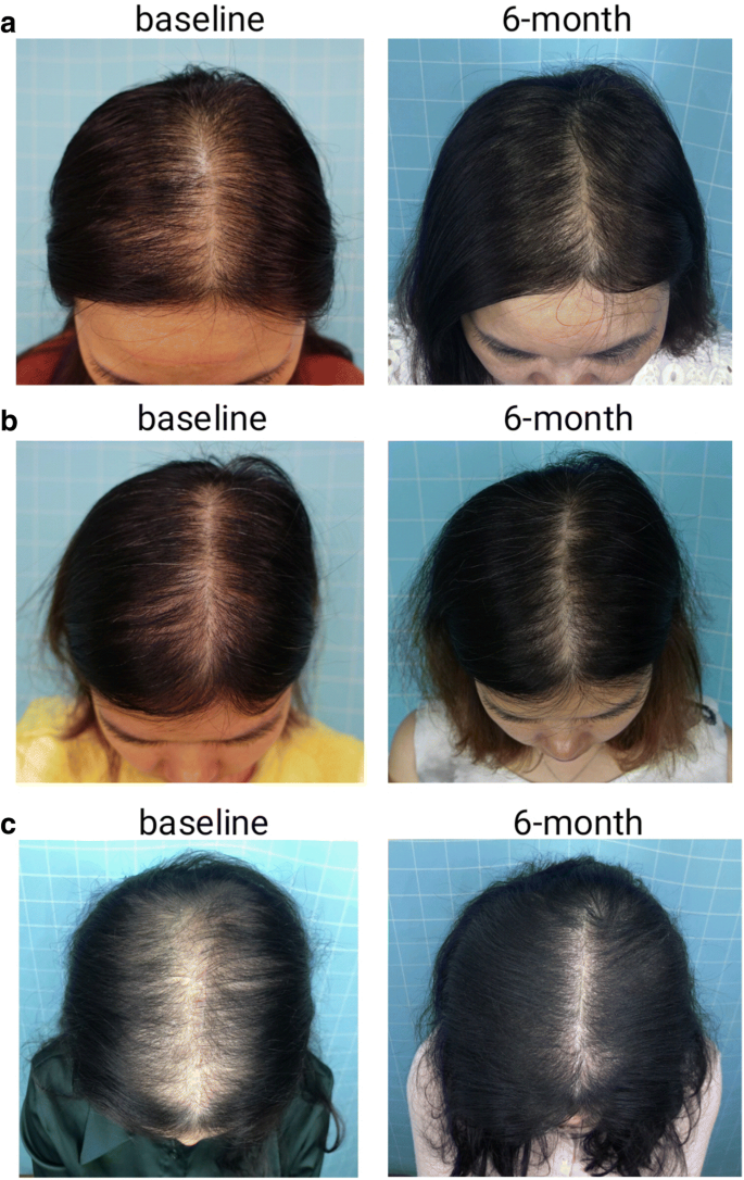 Comparison of low-level light therapy and combination therapy of 5%  minoxidil in the treatment of female pattern hair loss | SpringerLink