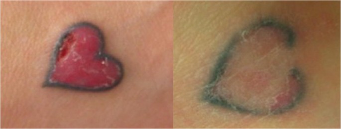 Ablative laser surgery for allergic tattoo reactions: a retrospective study  | SpringerLink