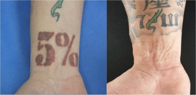 Ablative laser surgery for allergic tattoo reactions: a retrospective study  | SpringerLink