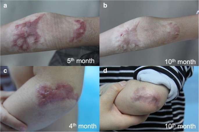 A retrospective study to identify the optimal parameters for pulsed dye  laser in the treatment of hypertrophic burn scars in Chinese children with  Fitzpatrick skin types III and IV | SpringerLink