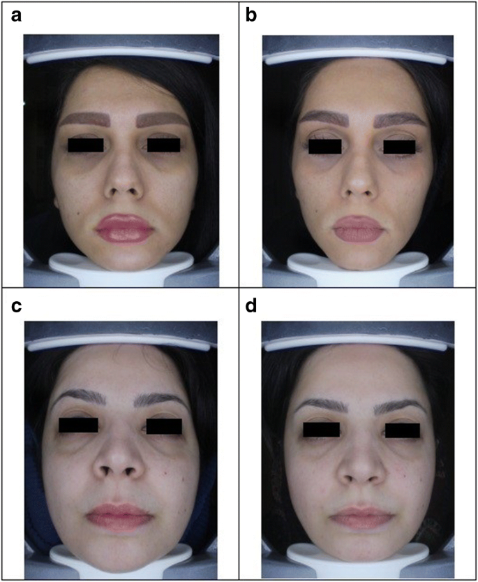 Comparison of carboxy therapy and fractional Q-switched ND:YAG laser on  periorbital dark circles treatment: a clinical trial | SpringerLink