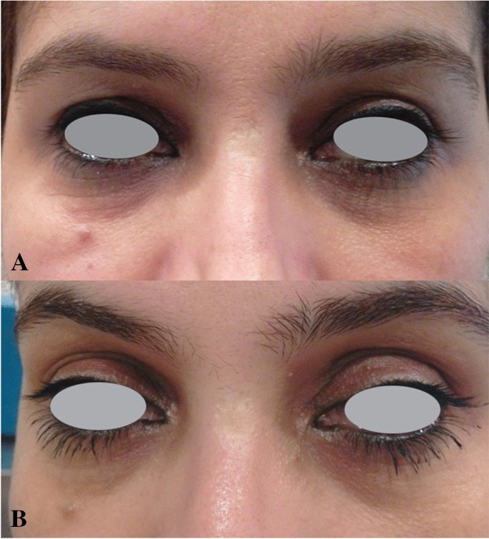Periocular rejuvenation using a unique non-ablative long-pulse 2940 nm Er:YAG  laser | Lasers in Medical Science