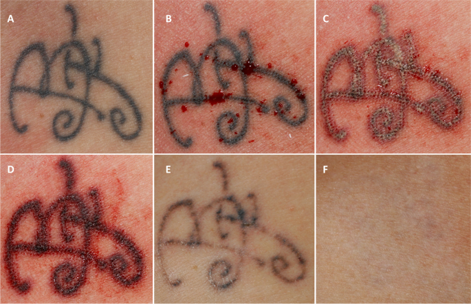  tattoo removal cost — a case series 