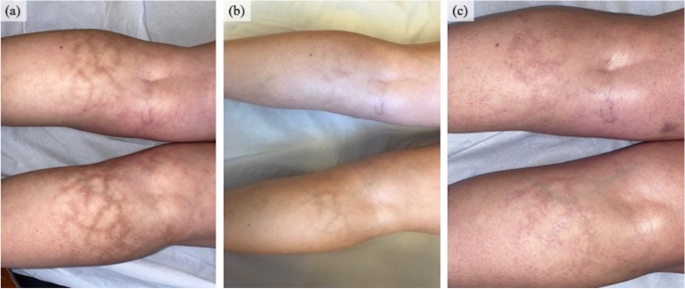 Erythema Ab Igne successfully treated with a 755-nm alexandrite picosecond  laser | SpringerLink