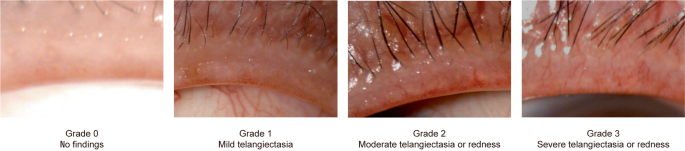 Effect of intense pulsed light using acne filter on eyelid margin  telangiectasia in moderate-to-severe meibomian gland dysfunction |  SpringerLink