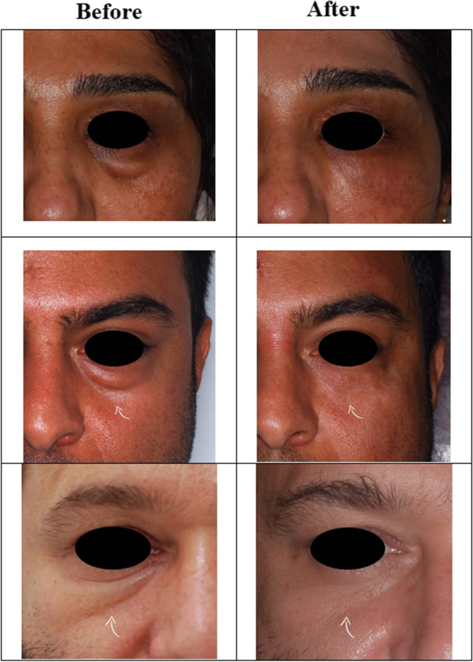Endolift Near Me