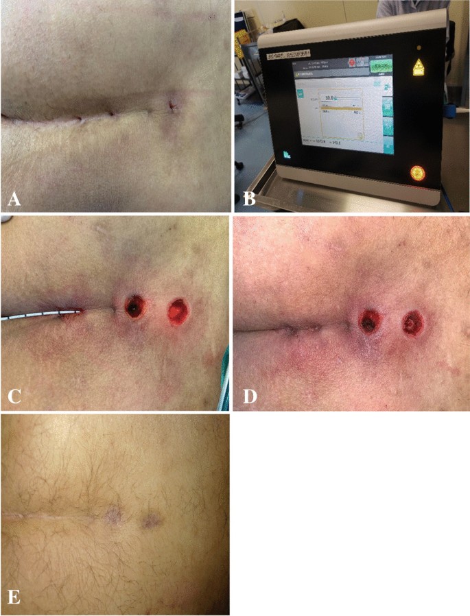 An effective and considerable treatment of pilonidal sinus disease by laser  ablation | SpringerLink