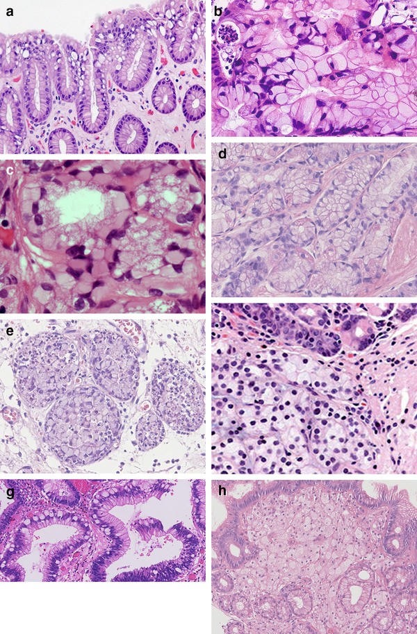Signet ring cell carcinoma of the rectal stump in a known ulcerative  colitis patient
