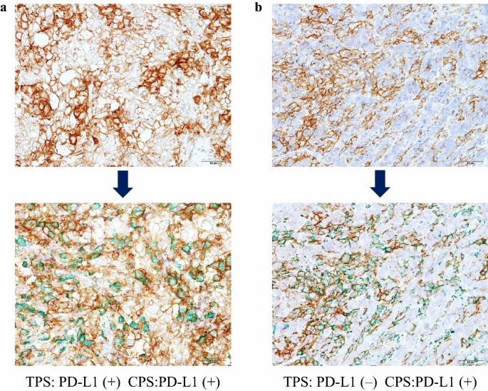 Prognostic impacts of the combined positive score and the tumor proportion  score for programmed death ligand-1 expression by double  immunohistochemical staining in patients with advanced gastric cancer |  SpringerLink