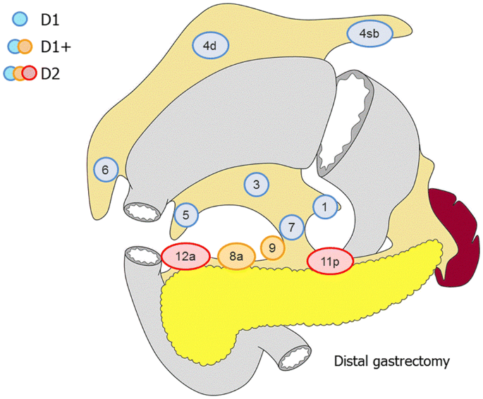 gastric cancer lymph node dissection