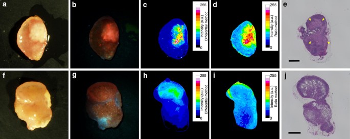 5 Ala Assistant Automated Detection Of Lymph Node Metastasis In Gastric Cancer Patients Springerlink