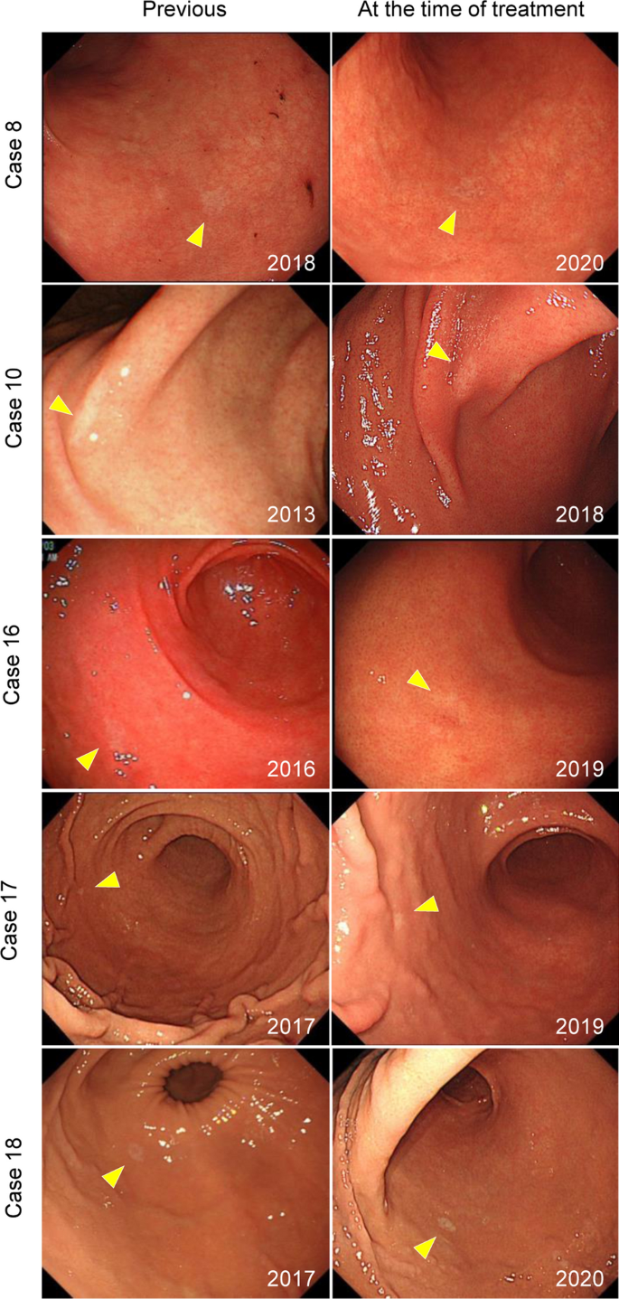 POR | Clinicopathological and Molecular Characteristics of Colorectal Signet  Ring Cell Carcinoma: A Review