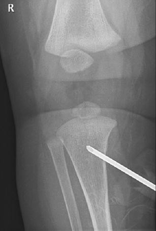 Cerebral Arterial Air Embolism In A Child After Intraosseous
