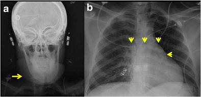 Scientific Educational Abstracts And Case Of The Day Presented At The Aser 2016 Annual Scientific Meeting And Postgraduate Course September 14 17 San Francisco California Springerlink
