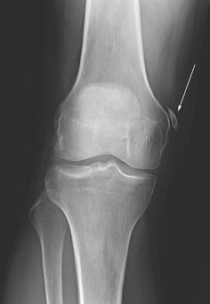 Core Curriculum Case Illustration Stieda Fracture Avulsion Fracture Of The Medial Femoral Condyle Springerlink