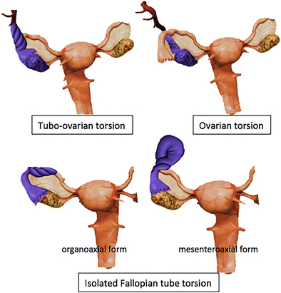 What Every Radiologist Should Know About Adnexal Torsion Springerlink