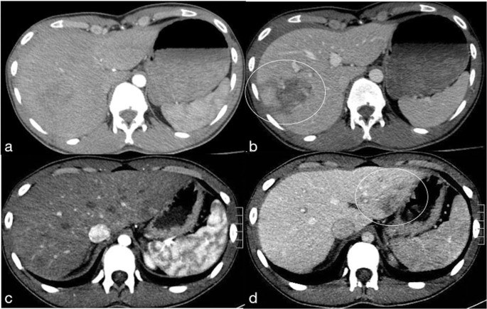 The Additional Value Of The Arterial Phase In The Ct Assessment Of Liver Vascular Injuries After High Energy Blunt Trauma Springerlink