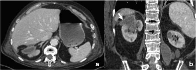 Ct Imaging Of Acute And Chronic Pyelonephritis A Practical Guide For Emergency Radiologists Springerlink