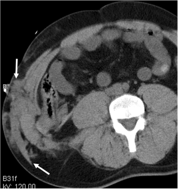 Early Bruising Following Abdominal Trauma Often Manifests As  