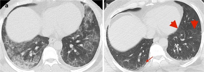 Chest CT in COVID-19 pneumonia: what are the findings in mid-term  follow-up? | SpringerLink