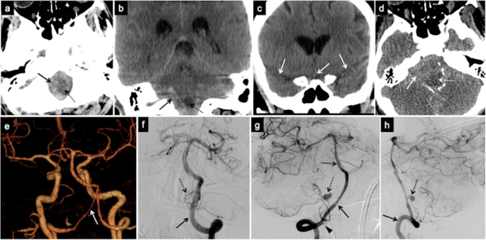 Imaging Evaluation of SAH and Aneurysm