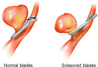 Scissoring of cerebral aneurysm clips: mechanical endurance of clip  twisting | SpringerLink