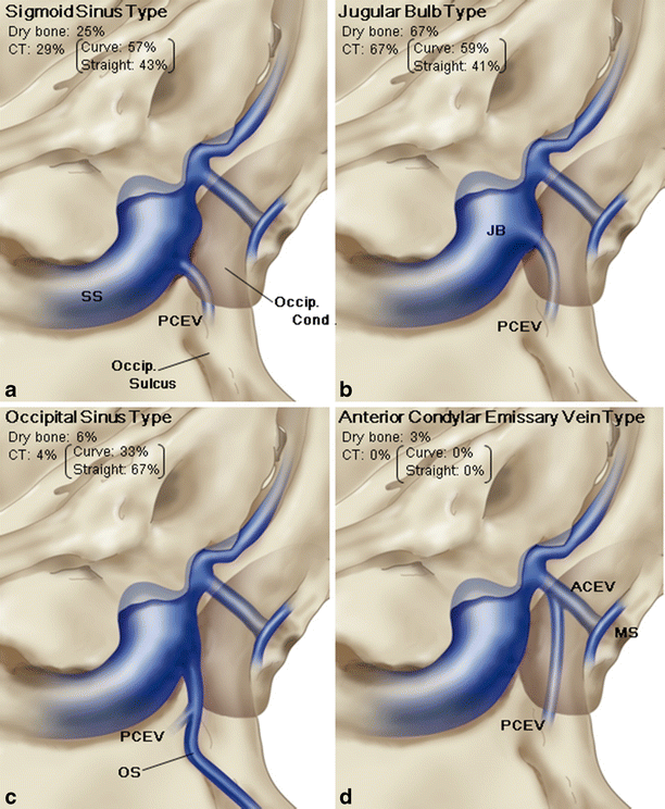 Posterior condylar canals and posterior condylar emissary veins—a  microsurgical and CT anatomical study | SpringerLink