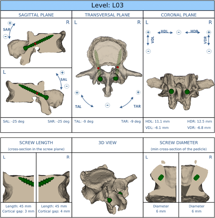Accuracy of cortical bone trajectory screw placement using patient-specific  template guide system | SpringerLink