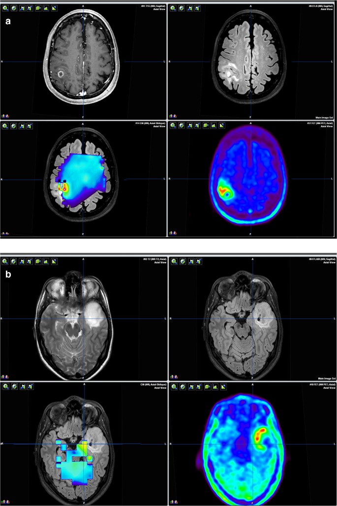 State-of-the-art imaging for glioma surgery | SpringerLink