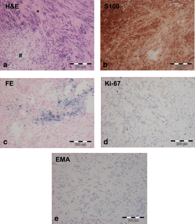 Spinal Intramedullary Schwannomas Report Of A Case And Extensive Review Of The Literature Springerlink