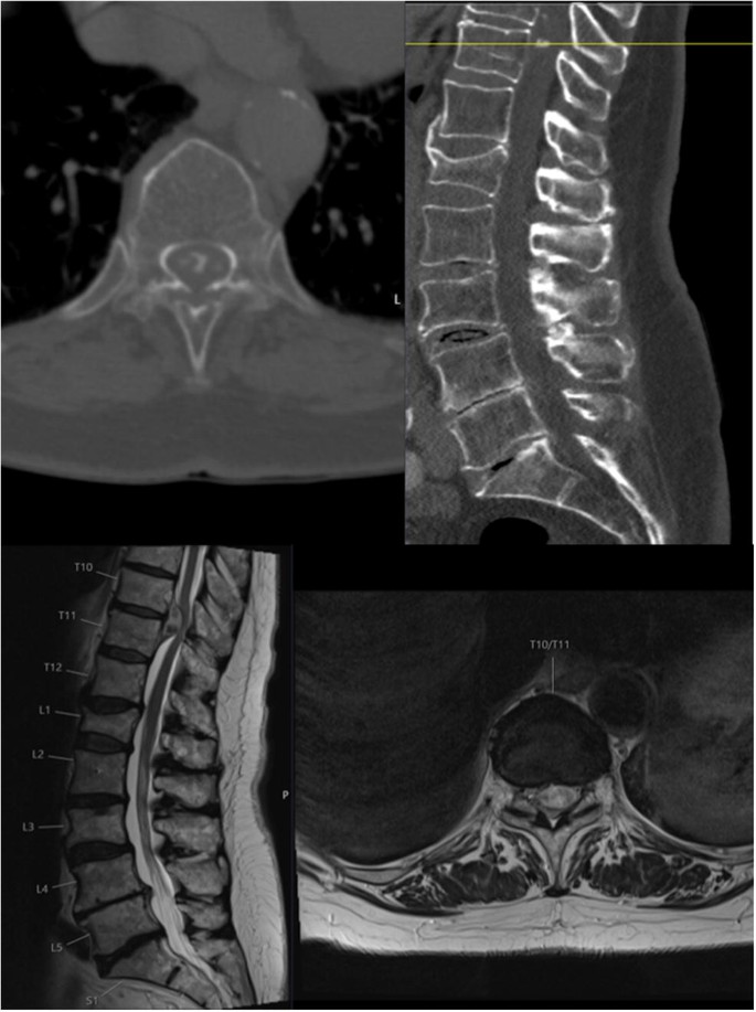 Posterior Transdural Resection Of Giant Calcified Thoracic Disc Herniation In A Case Series Of 12 Patients Springerlink