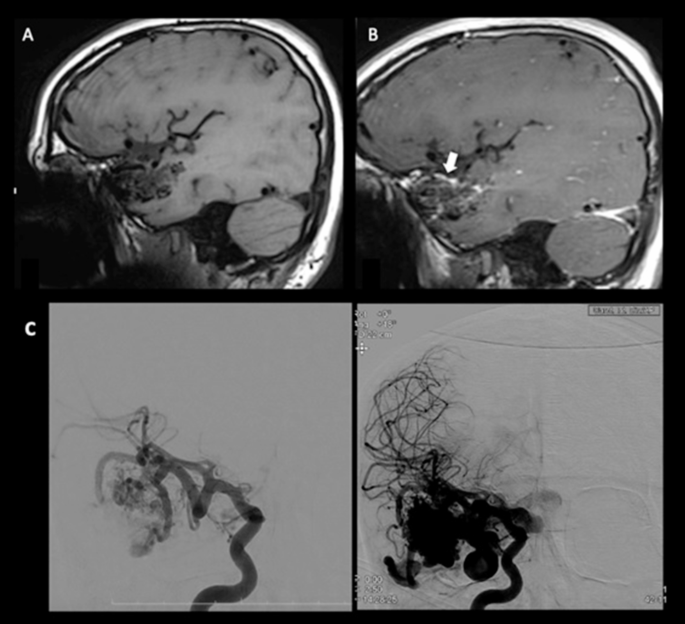 Risk assessment for rupture of brain arteriovenous malformations using ...