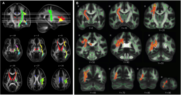 Wartime blast induced mild traumatic brain injury in the military ...