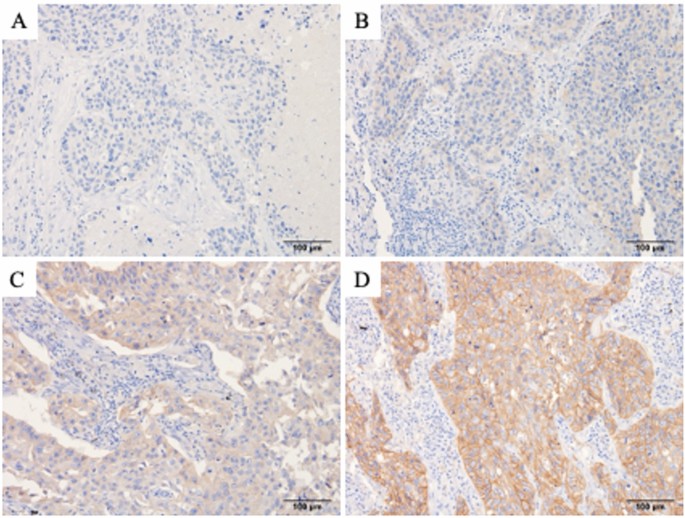 Clinical significance of CD155 expression in surgically resected lung