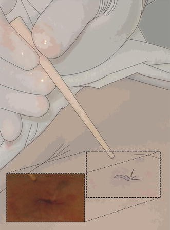 A low-output colocutaneous fistula healed by Surgisis anal plug | Techniques in Coloproctology | Springer Nature Link A low-output colocutaneous fistula healed by Surgisis anal plug | Techniques in Coloproctology | Springer Nature Link