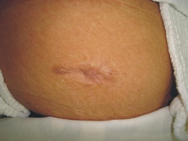 A low-output colocutaneous fistula healed by Surgisis anal plug | Techniques in Coloproctology | Springer Nature Link A low-output colocutaneous fistula healed by Surgisis anal plug | Techniques in Coloproctology | Springer Nature Link