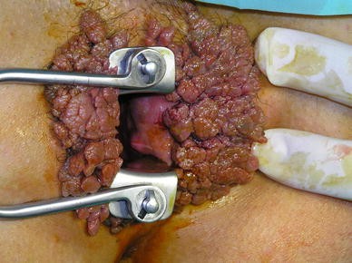 a chirurgitron condyloma gyógyulása enterobius vermicularis oxyure