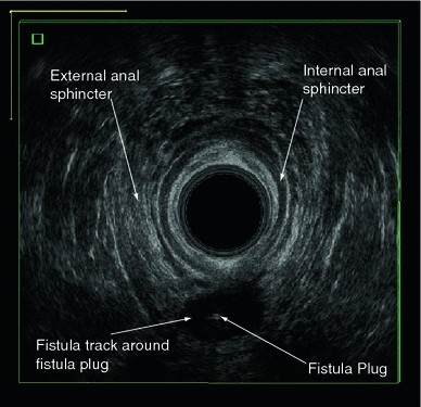 surgisis anal fistula plug INYA Alpine Vibrating Silicone Anal Plug with Remote Control, Teal main image 0