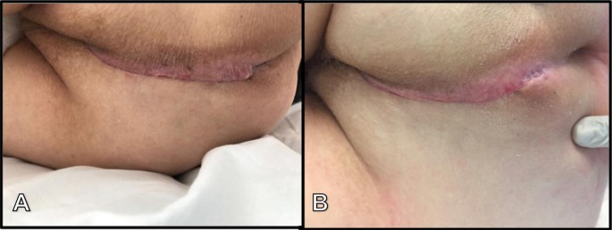 Feasibility of a subcutaneous gluteal turnover flap without donor site scar  for perineal closure after abdominoperineal resection for rectal cancer |  SpringerLink