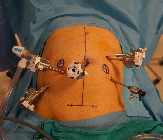 The da Vinci Xi system for robotic total/subtotal colectomy vs.  conventional laparoscopy: short-term outcomes | SpringerLink