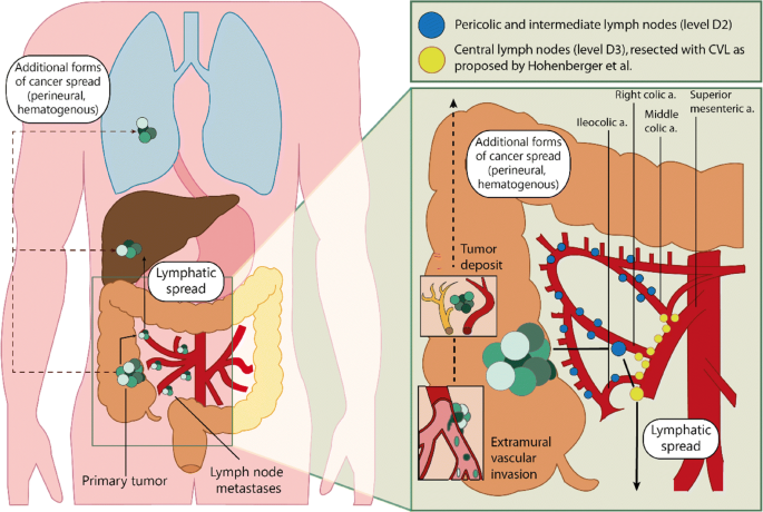 More Extensive Lymphadenectomy In Colon Cancer; How Far Are We Willing To  Go For A Biomarker? | Springerlink