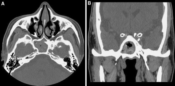 Headache Induced By Isolated Sphenoid Fungal Sinusitis Sinus Headache The Journal Of Headache And Pain Full Text Headache Induced By Isolated Sphenoid Fungal Sinusitis Sinus Headache The Journal Of Headache And Pain Full Text